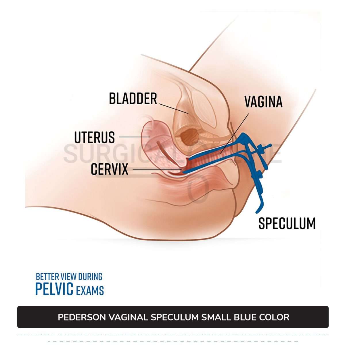 Lletz Coated Pederson Vaginal Speculum Small, 1/2" (1.3 cm) X 3" (7.6 cm)