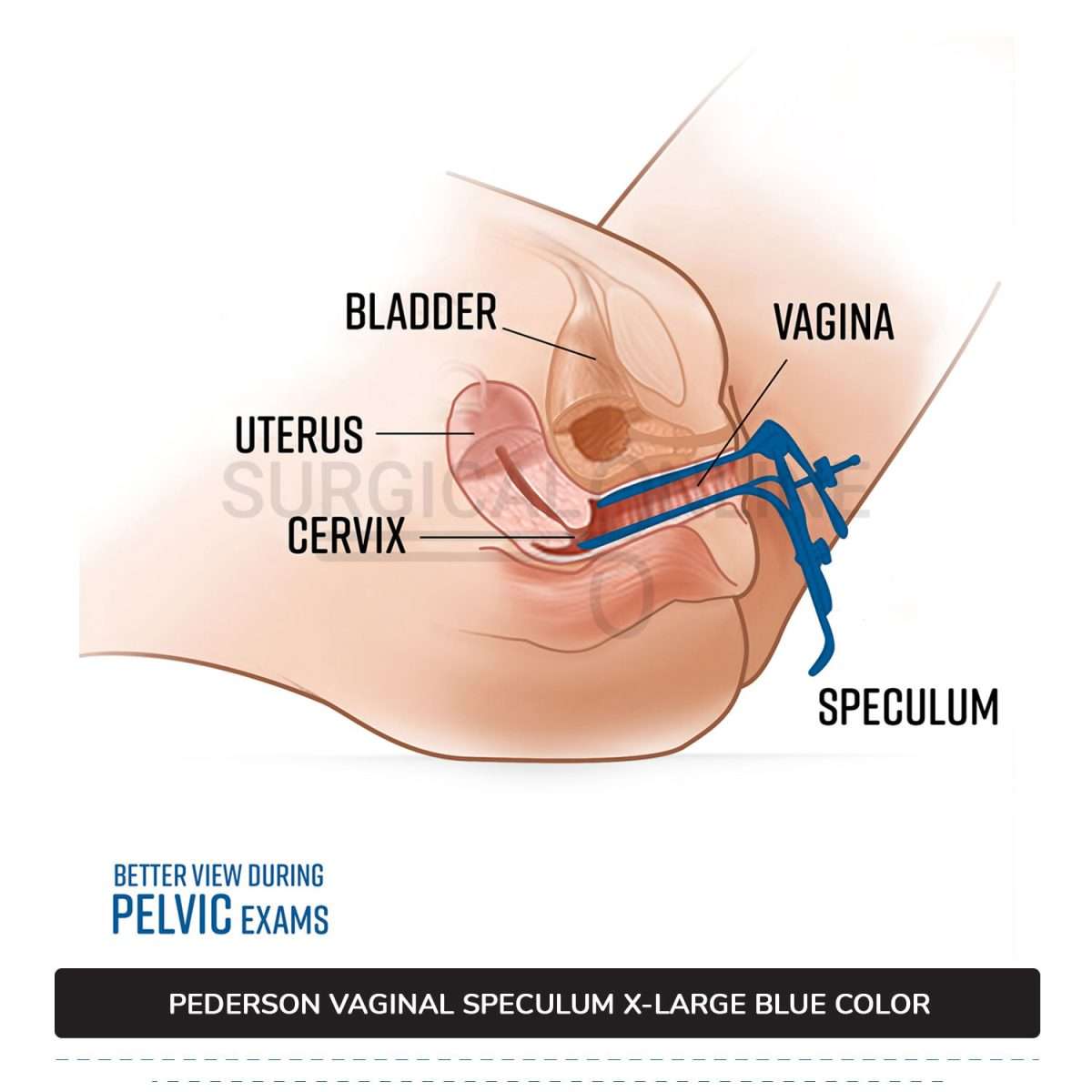 Set of 3 Pcs Pederson Vaginal Speculum LLETZ LEEP Blue Teflon Cover