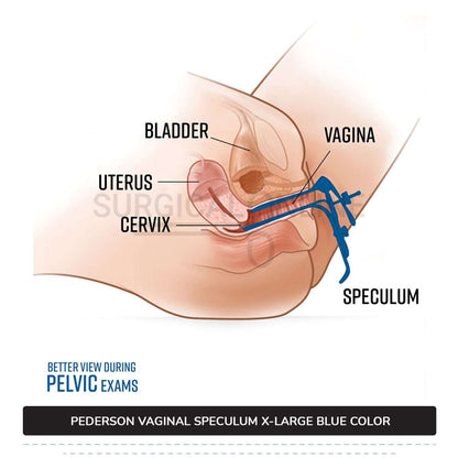 Set of 3 Pcs Pederson Vaginal Speculum LLETZ LEEP Blue Teflon Cover